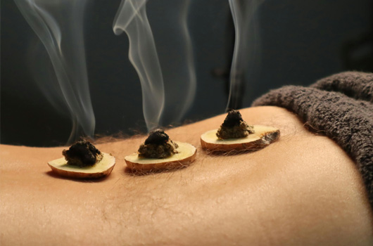Acupunctuur overigen Acupunctuur overigen