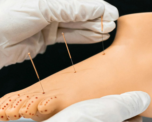 Wat is acupunctuur