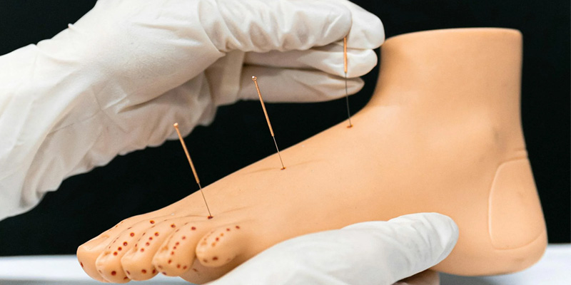 Wat is acupunctuur